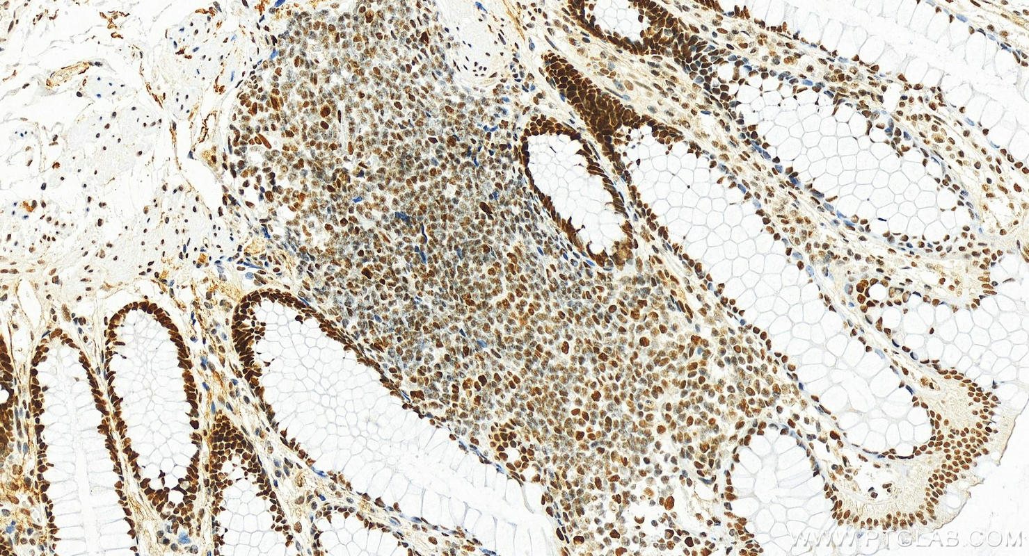 Immunohistochemistry (IHC) staining of human colon tissue using MSH2 Recombinant antibody (82775-1-RR)