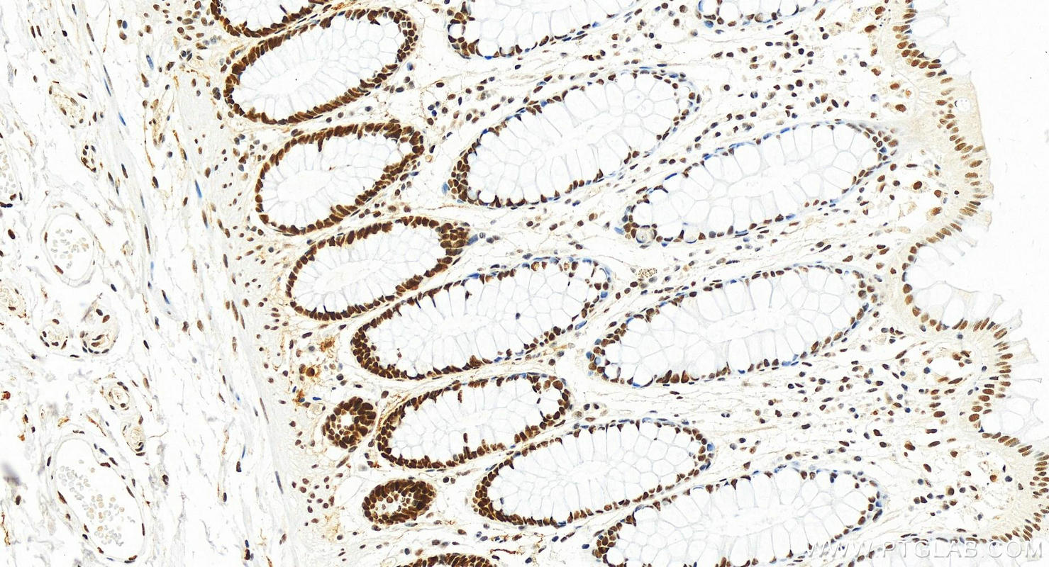 Immunohistochemistry (IHC) staining of human colon tissue using MSH2 Recombinant antibody (82775-1-RR)