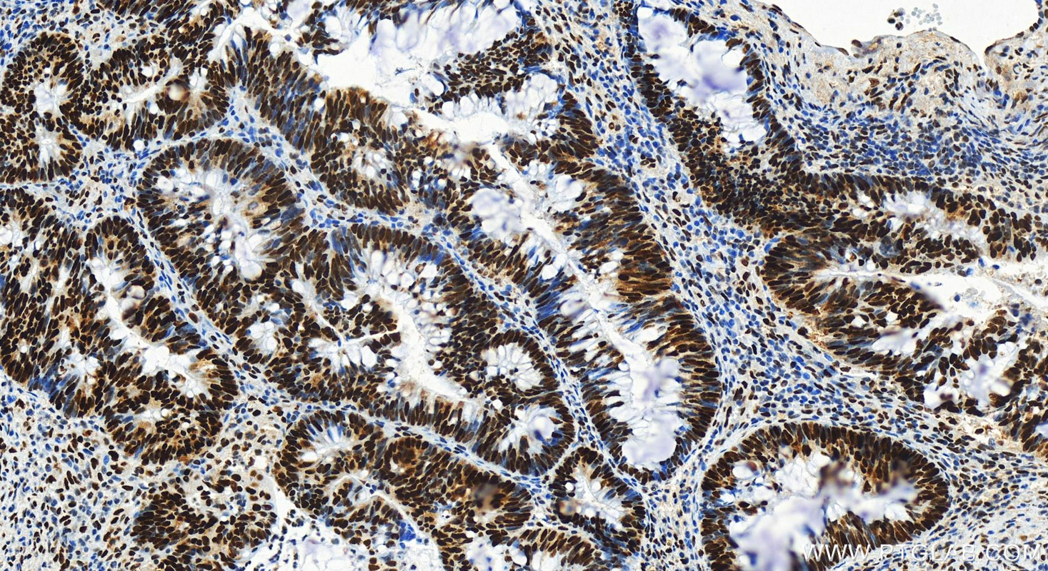 Immunohistochemistry (IHC) staining of human colon  cancer using MSH2 Recombinant antibody (82775-1-RR)