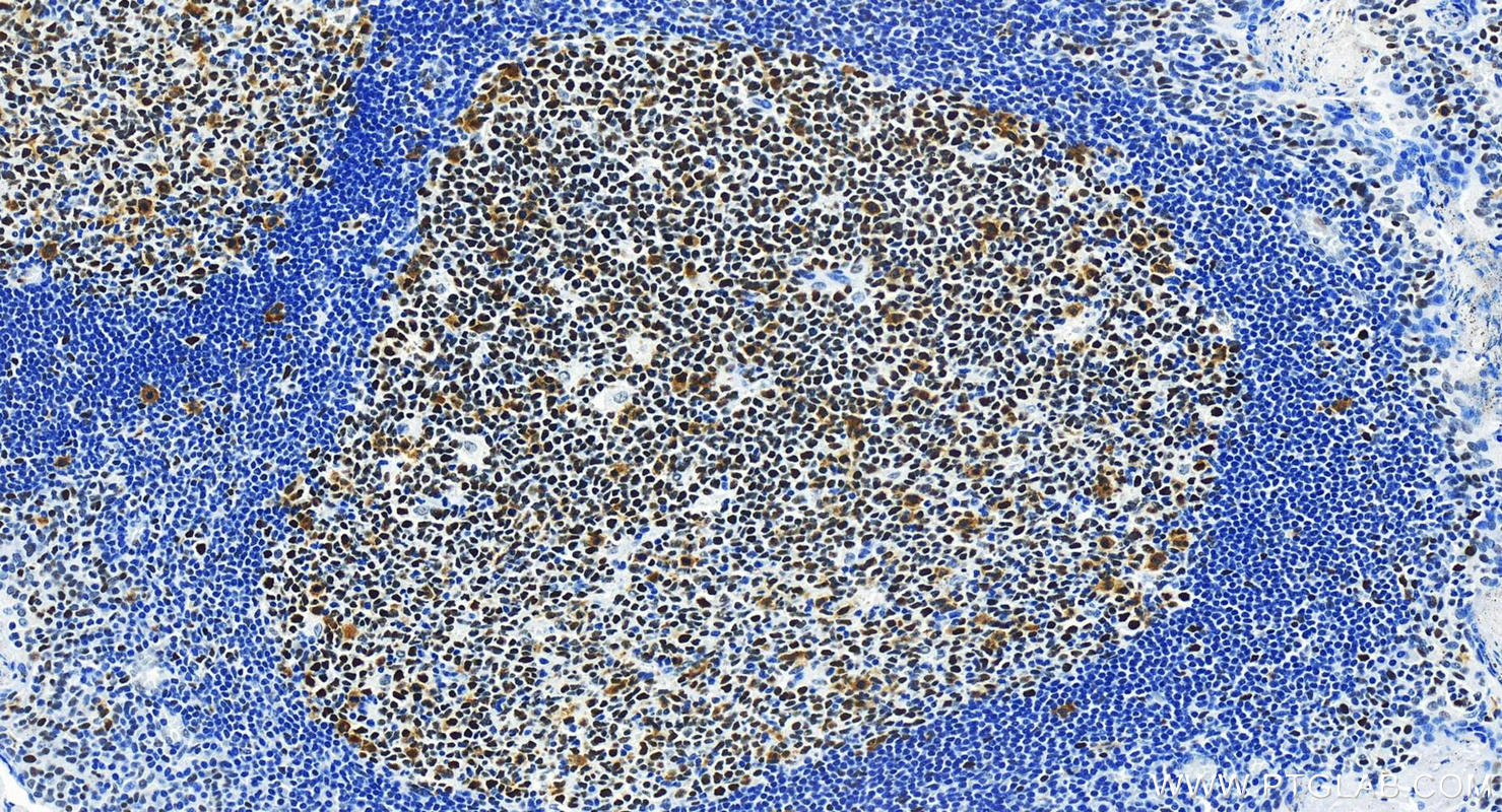 Immunohistochemistry (IHC) staining of human tonsillitis tissue using MSH2 Recombinant antibody (82775-1-RR)