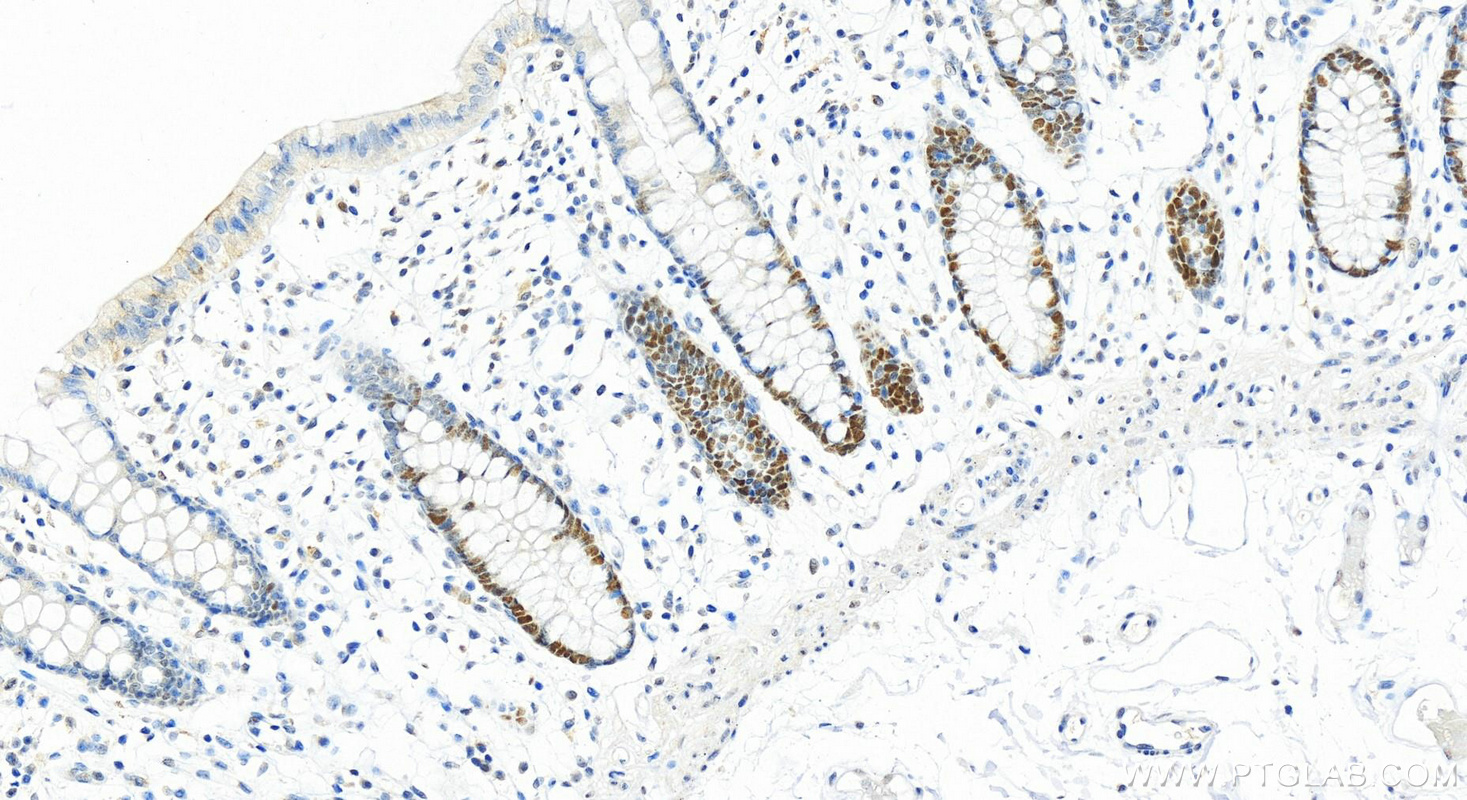 Immunohistochemistry (IHC) staining of human colon tissue using MSH6 Polyclonal antibody (18120-1-AP)