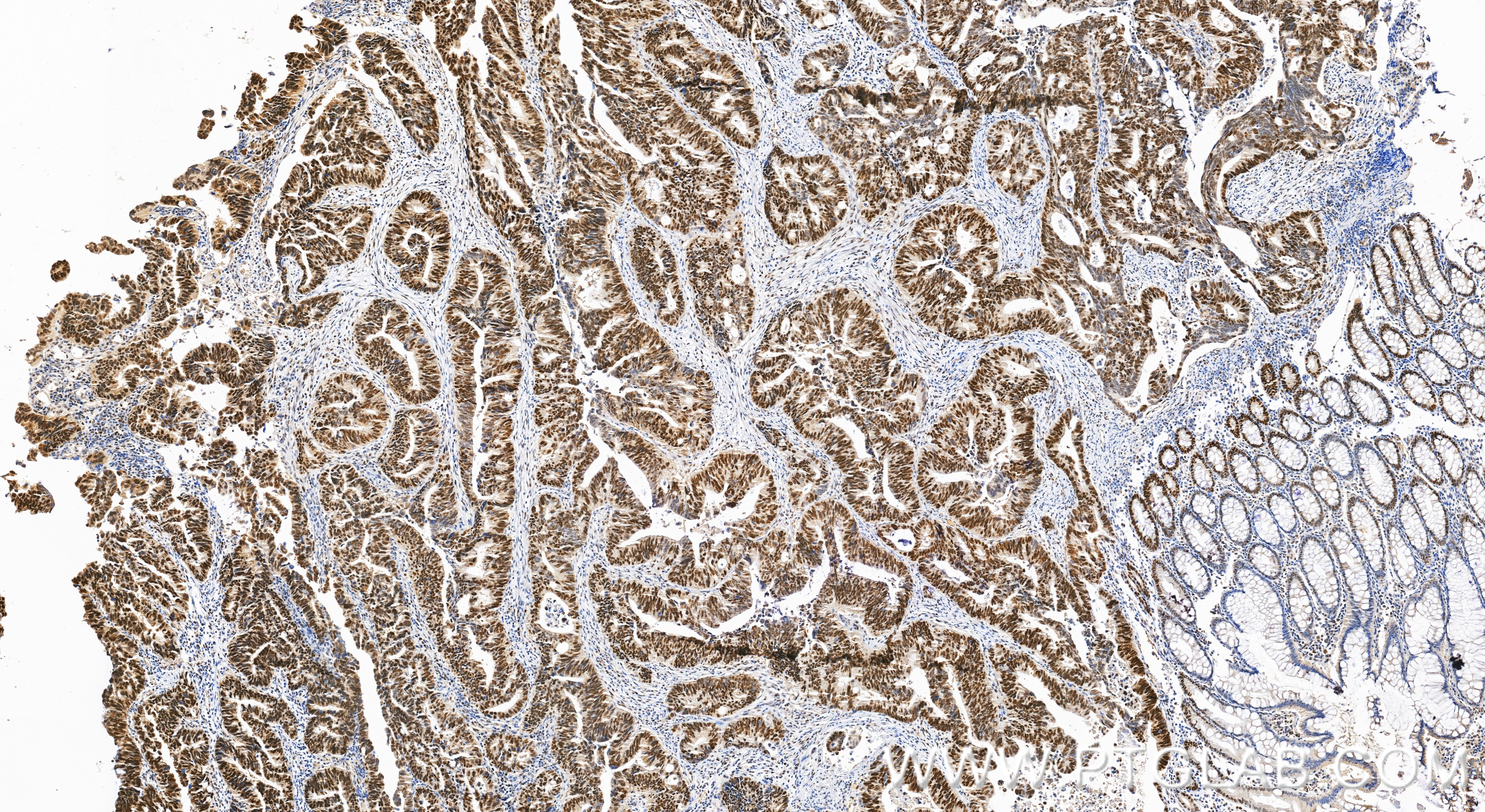 Immunohistochemistry (IHC) staining of human colon cancer tissue using MSH6 Polyclonal antibody (18120-1-AP)