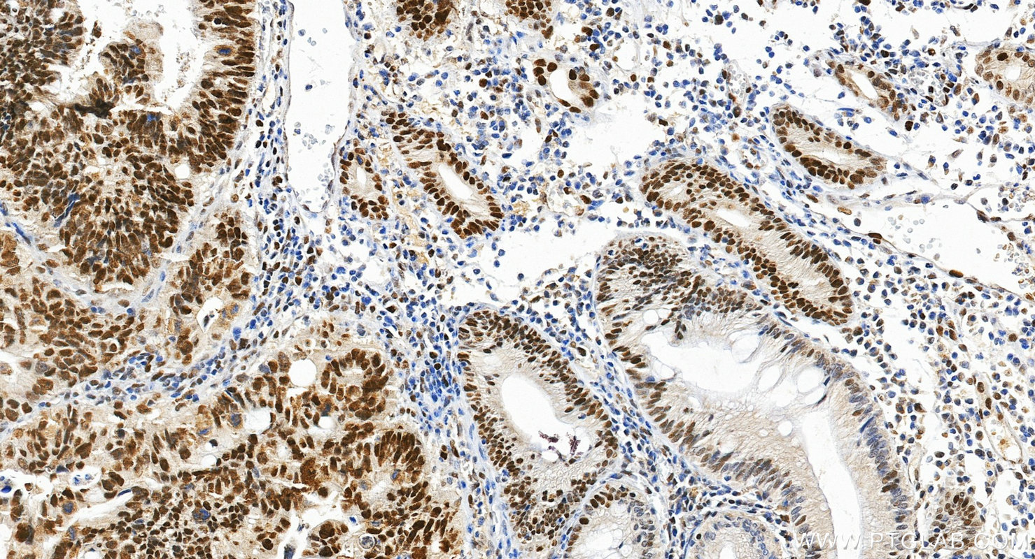 Immunohistochemistry (IHC) staining of human colon cancer tissue using MSH6 Polyclonal antibody (18120-1-AP)