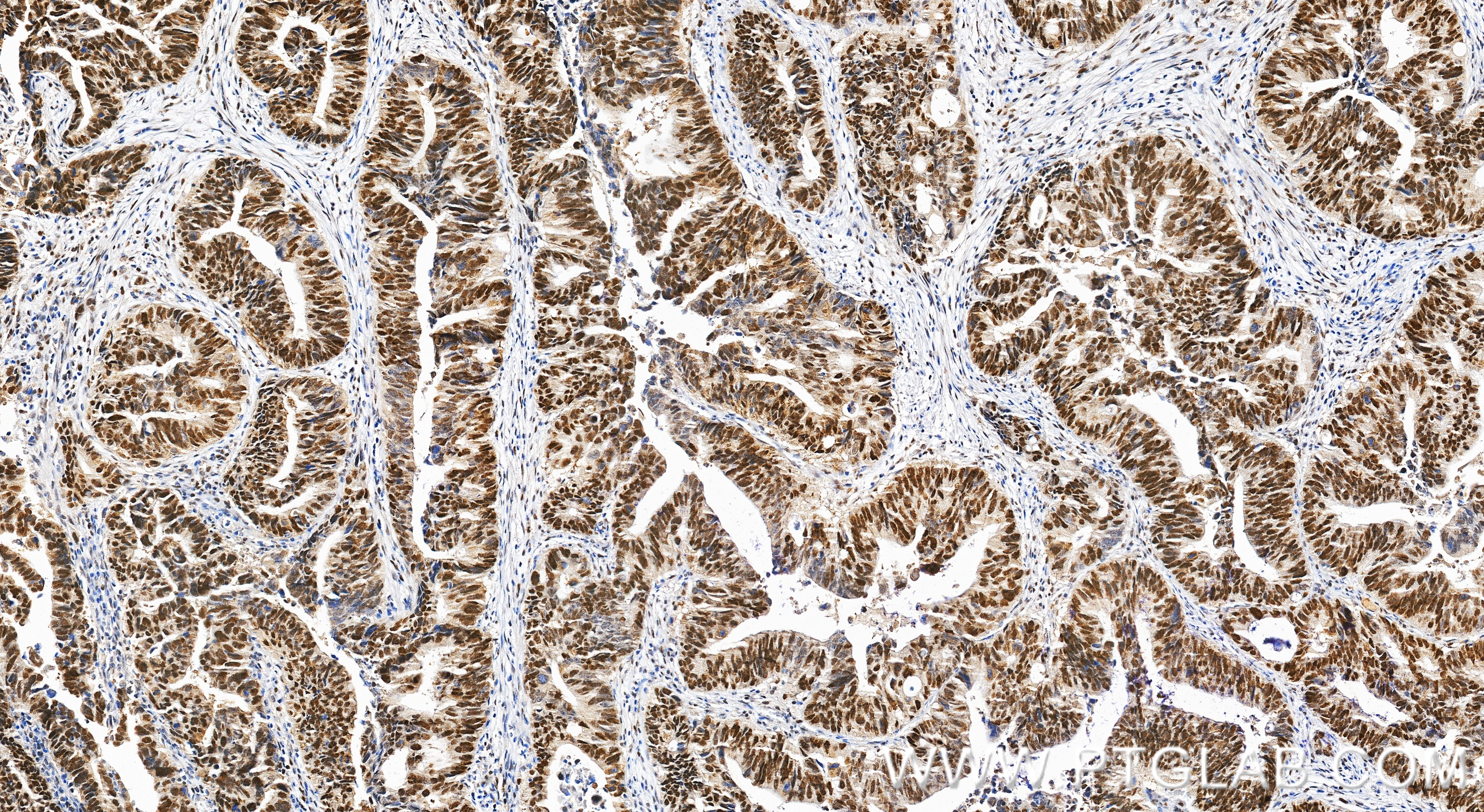 Immunohistochemistry (IHC) staining of human colon cancer tissue using MSH6 Polyclonal antibody (18120-1-AP)