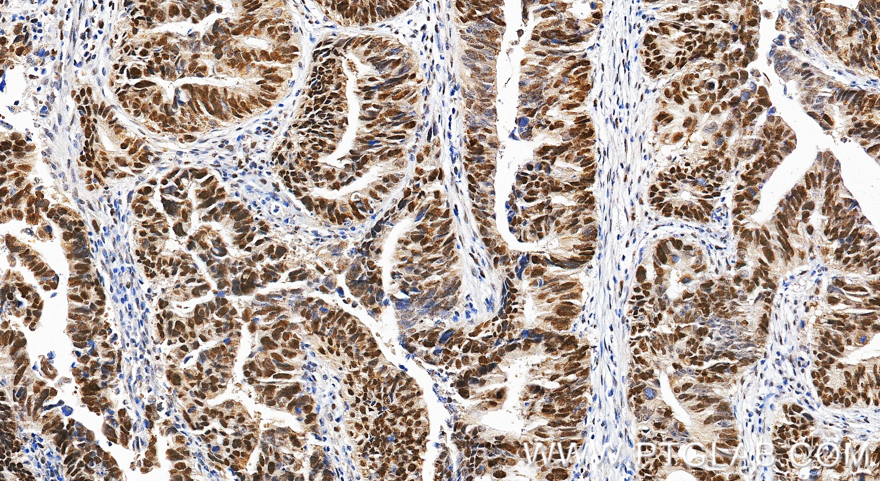 Immunohistochemistry (IHC) staining of human colon cancer tissue using MSH6 Polyclonal antibody (18120-1-AP)