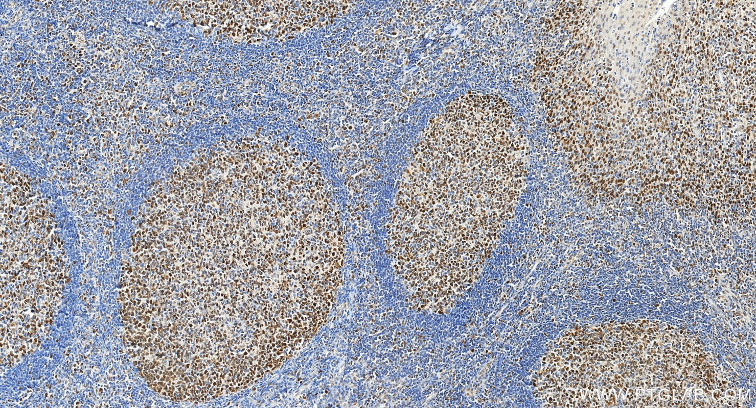 Immunohistochemistry (IHC) staining of human tonsillitis tissue using MSH6 Polyclonal antibody (18120-1-AP)