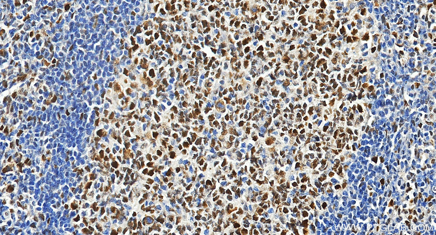 Immunohistochemistry (IHC) staining of human tonsillitis tissue using MSH6 Polyclonal antibody (18120-1-AP)