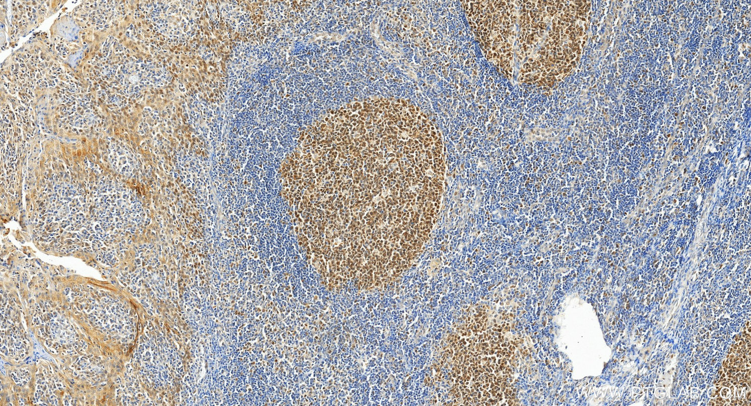 Immunohistochemistry (IHC) staining of human tonsillitis tissue using MSH6 Monoclonal antibody (66172-1-Ig)