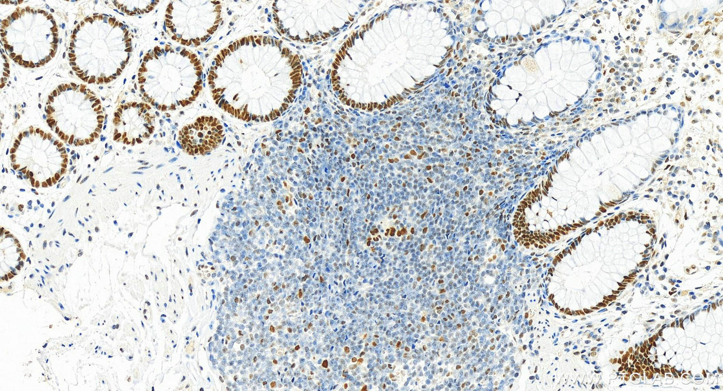 Immunohistochemistry (IHC) staining of human colon tissue using MSH6 Monoclonal antibody (66172-2-Ig)