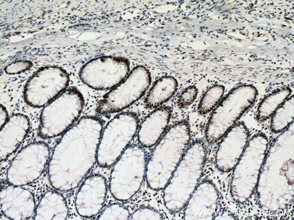 Immunohistochemistry (IHC) staining of human colon cancer tissue using MSH6 Monoclonal antibody (66172-2-Ig)