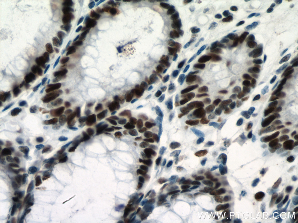 Immunohistochemistry (IHC) staining of human colon cancer tissue using MSH6 Monoclonal antibody (66172-2-Ig)