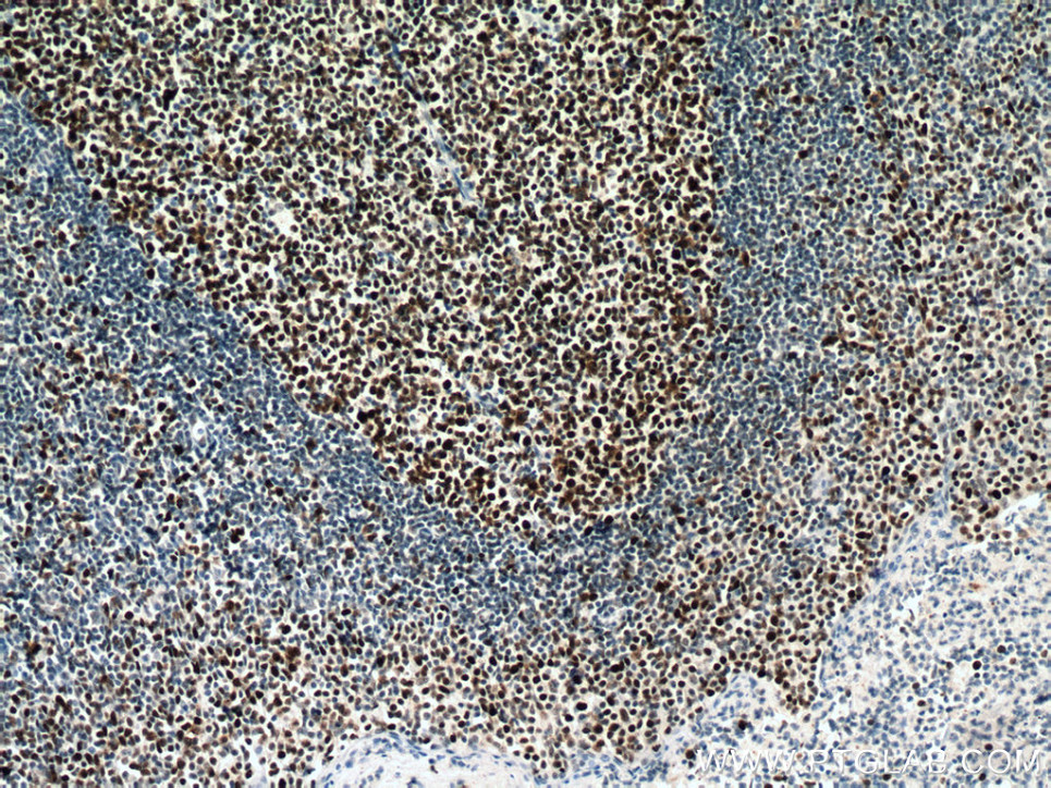 Immunohistochemistry (IHC) staining of human tonsillitis tissue using MSH6 Monoclonal antibody (66172-2-Ig)