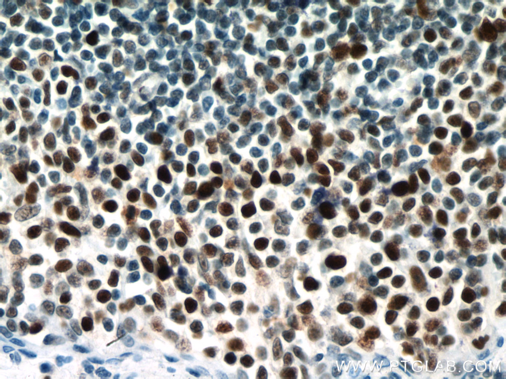 Immunohistochemistry (IHC) staining of human tonsillitis tissue using MSH6 Monoclonal antibody (66172-2-Ig)