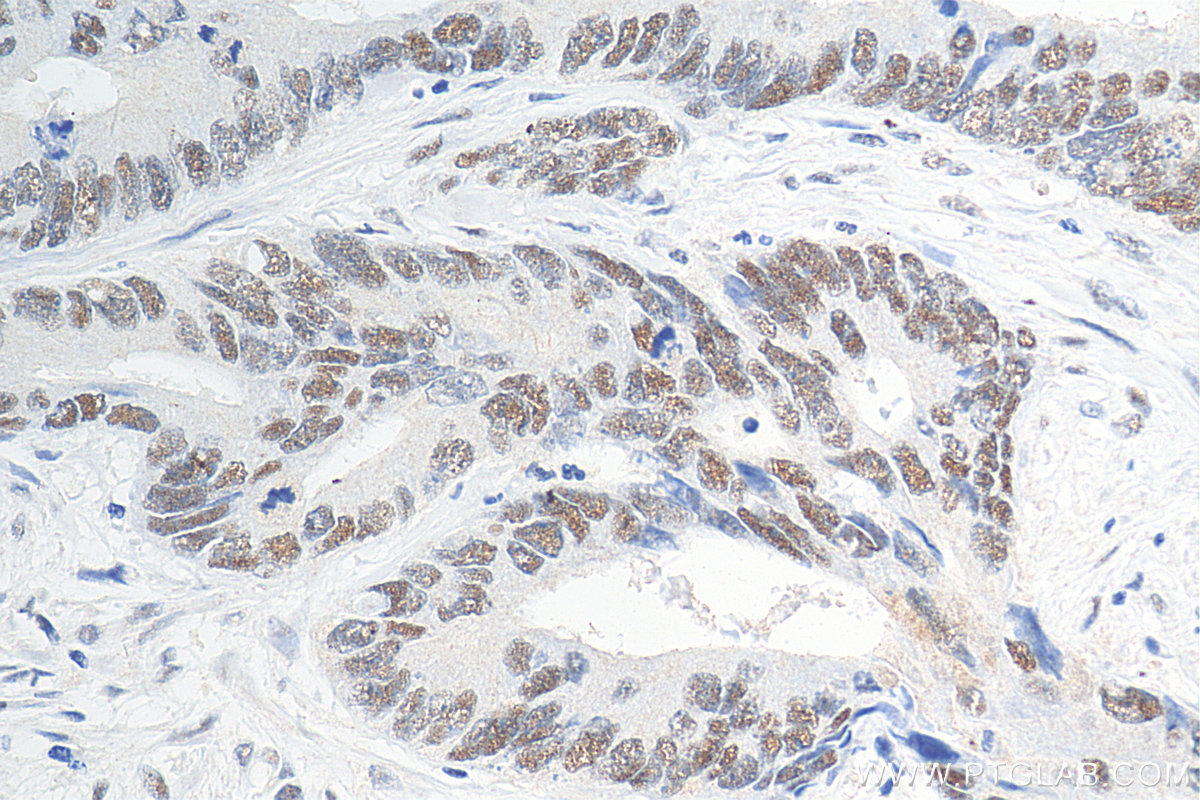 Immunohistochemistry (IHC) staining of human colon cancer tissue using MSH6 Monoclonal antibody (66172-2-Ig)