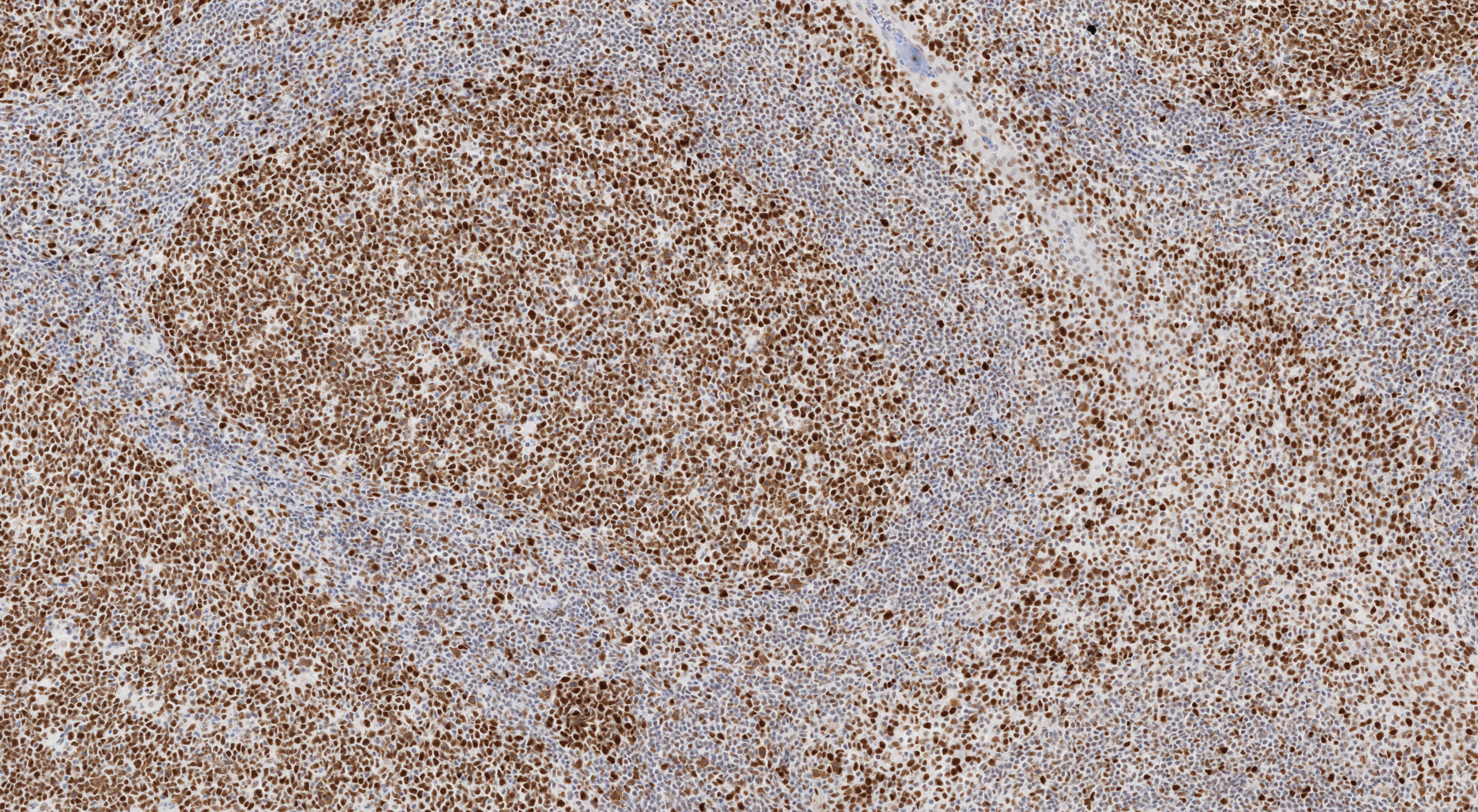 Immunohistochemistry (IHC) staining of human tonsillitis tissue using MSH6 Monoclonal antibody (66172-2-Ig)