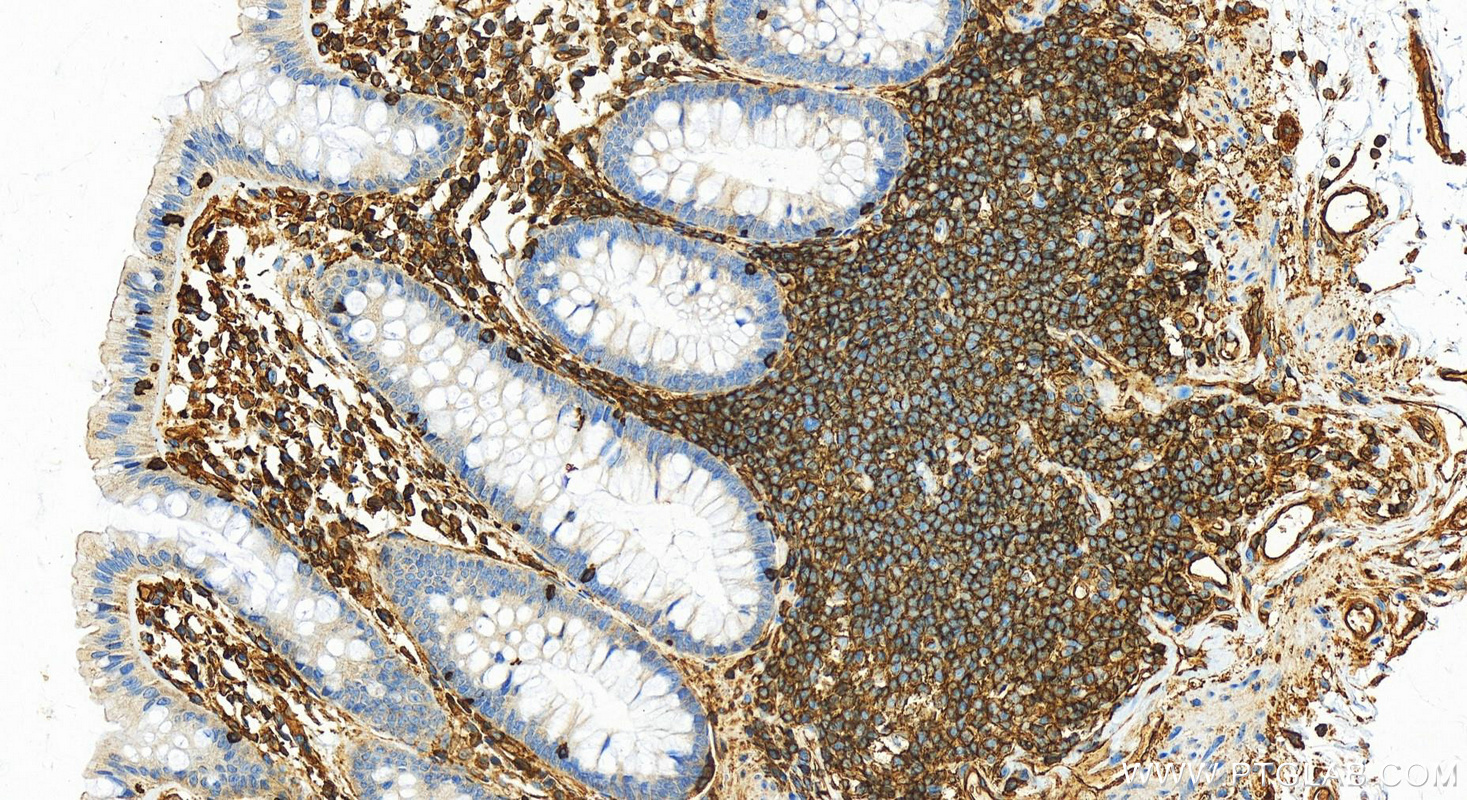 Immunohistochemistry (IHC) staining of human colon tissue using Moesin Polyclonal antibody (26053-1-AP)