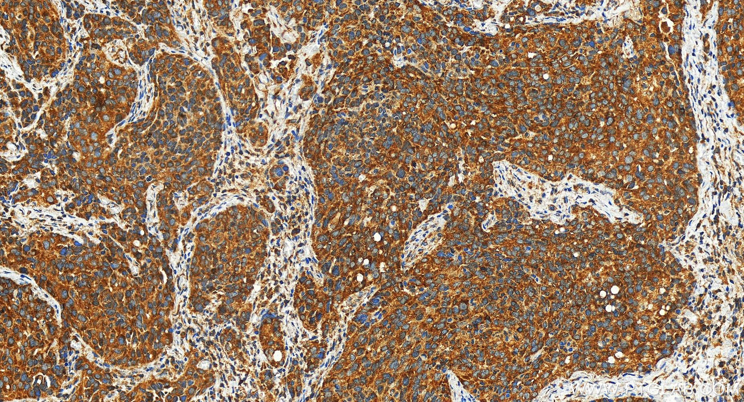 Immunohistochemistry (IHC) staining of human ovary cancer tissue using MSTO1 Polyclonal antibody (28400-1-AP)