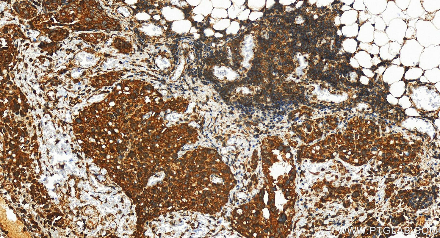 Immunohistochemistry (IHC) staining of human ovary cancer tissue using MSTO1 Polyclonal antibody (28400-1-AP)