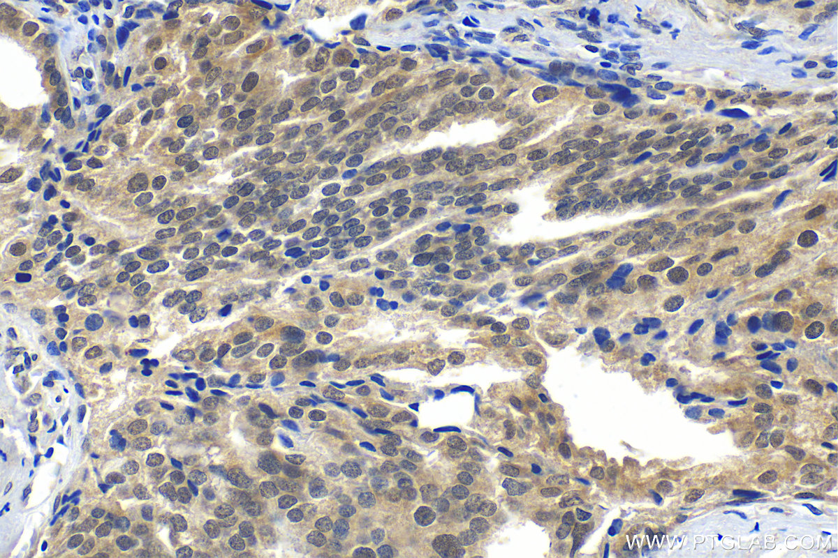 Immunohistochemistry (IHC) staining of human prostate cancer tissue using MTA1 Polyclonal antibody (30545-1-AP)