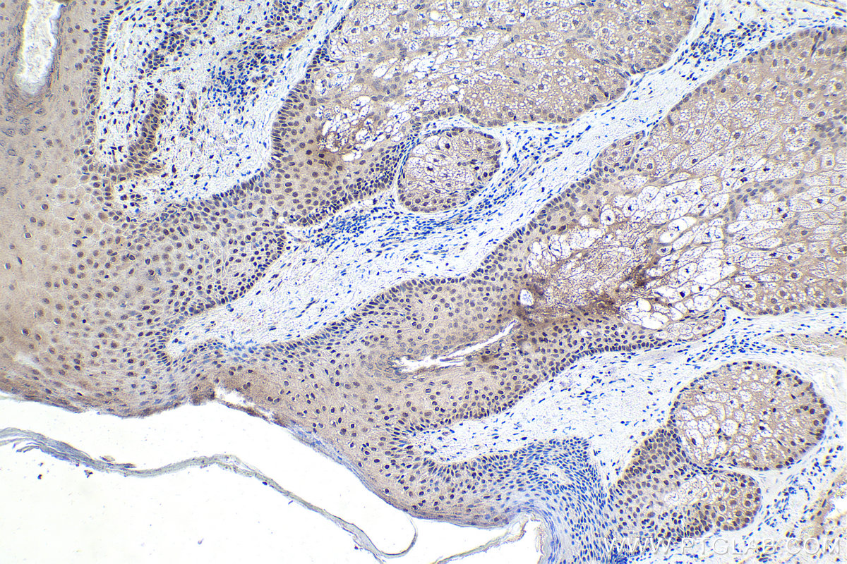 Immunohistochemistry (IHC) staining of human skin cancer tissue using MTA1 Polyclonal antibody (30545-1-AP)