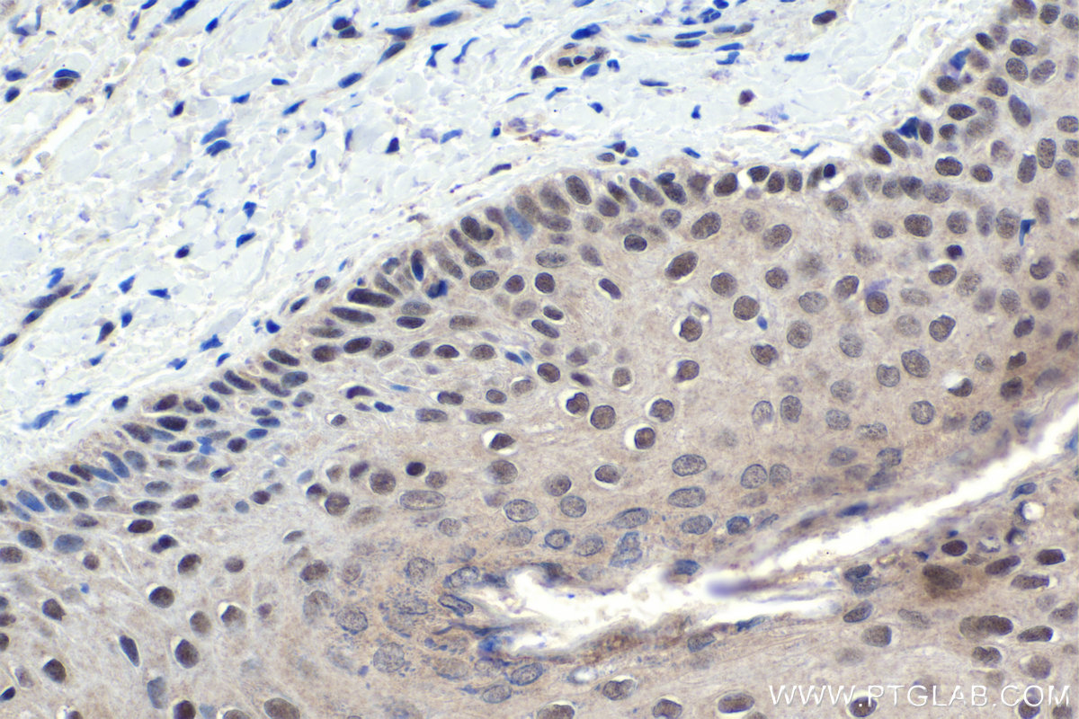 Immunohistochemistry (IHC) staining of human skin cancer tissue using MTA1 Polyclonal antibody (30545-1-AP)