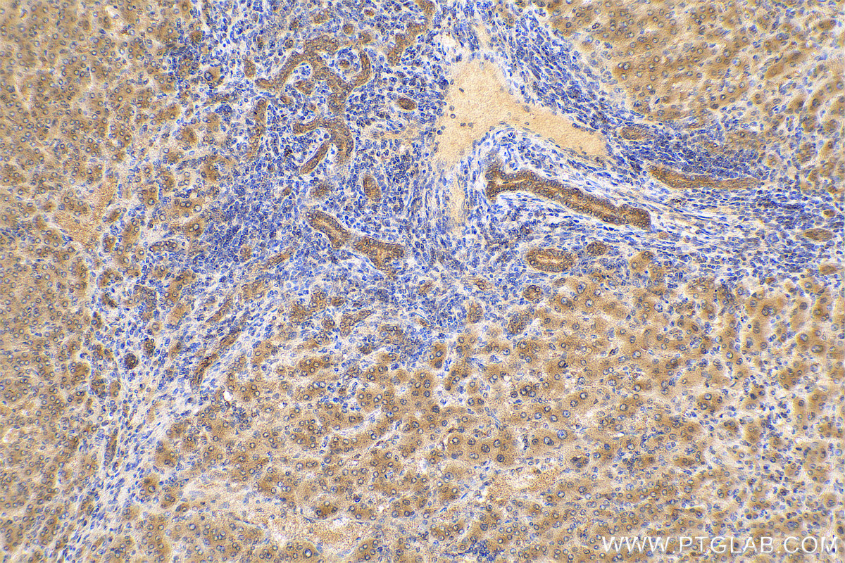 Immunohistochemistry (IHC) staining of human liver cancer tissue using MTAP Polyclonal antibody (11475-1-AP)