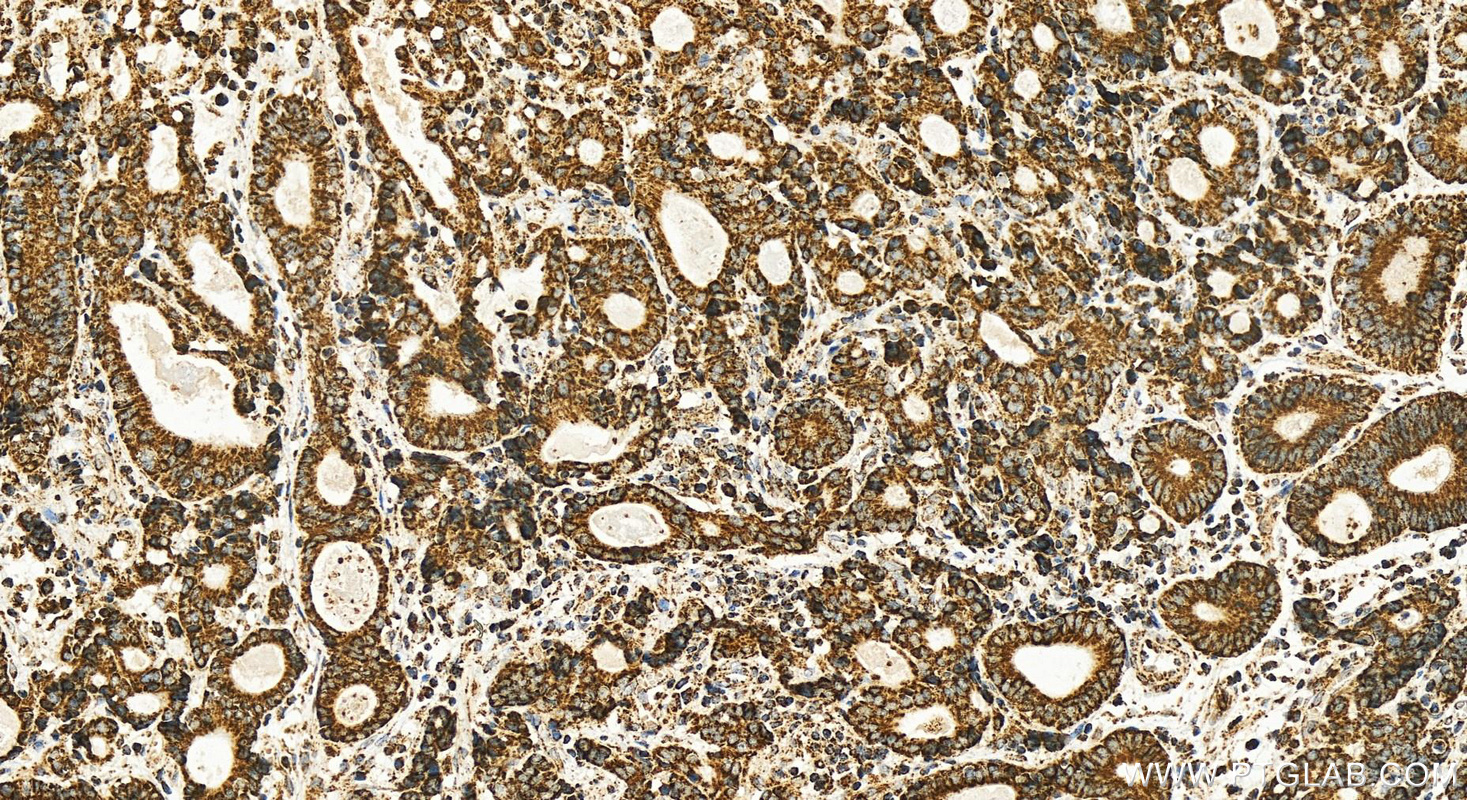 Immunohistochemistry (IHC) staining of human stomach cancer tissue using MTCO2 Recombinant antibody (83132-7-RR)