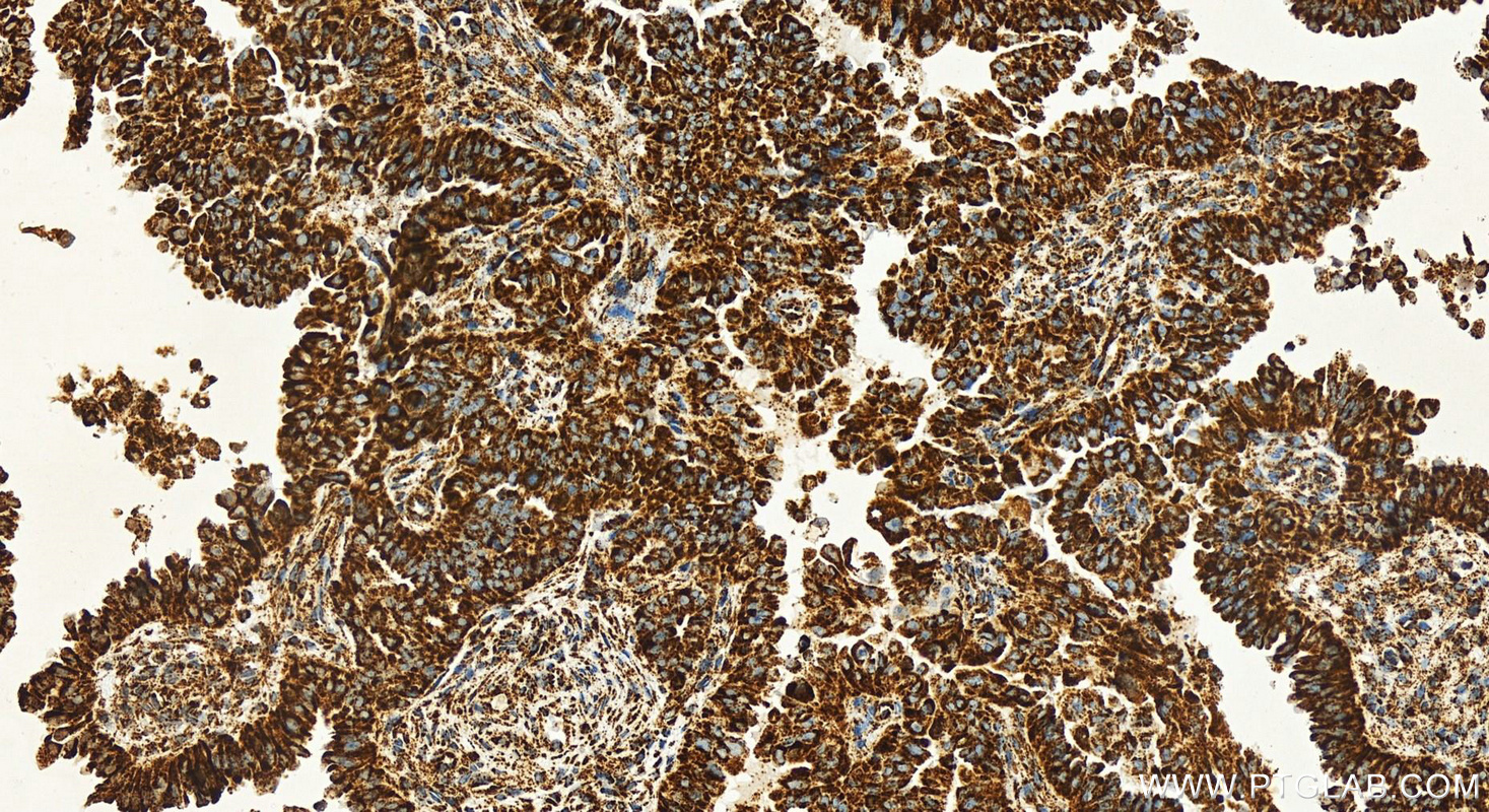 Immunohistochemistry (IHC) staining of human ovarian cancer using MTCO2 Recombinant antibody (83132-7-RR)