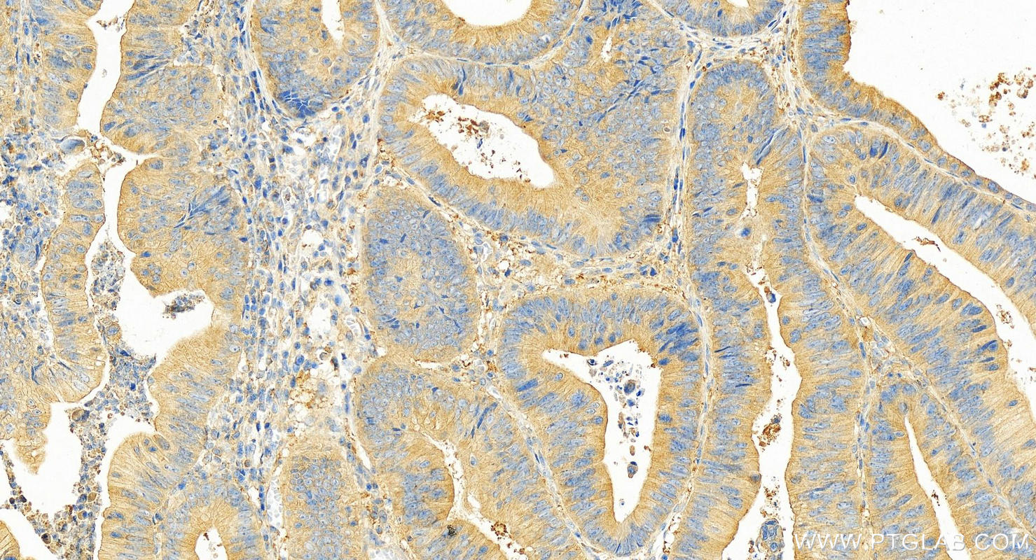 Immunohistochemistry (IHC) staining of human colon cancer tissue using MTHFD1 Polyclonal antibody (10794-1-AP)