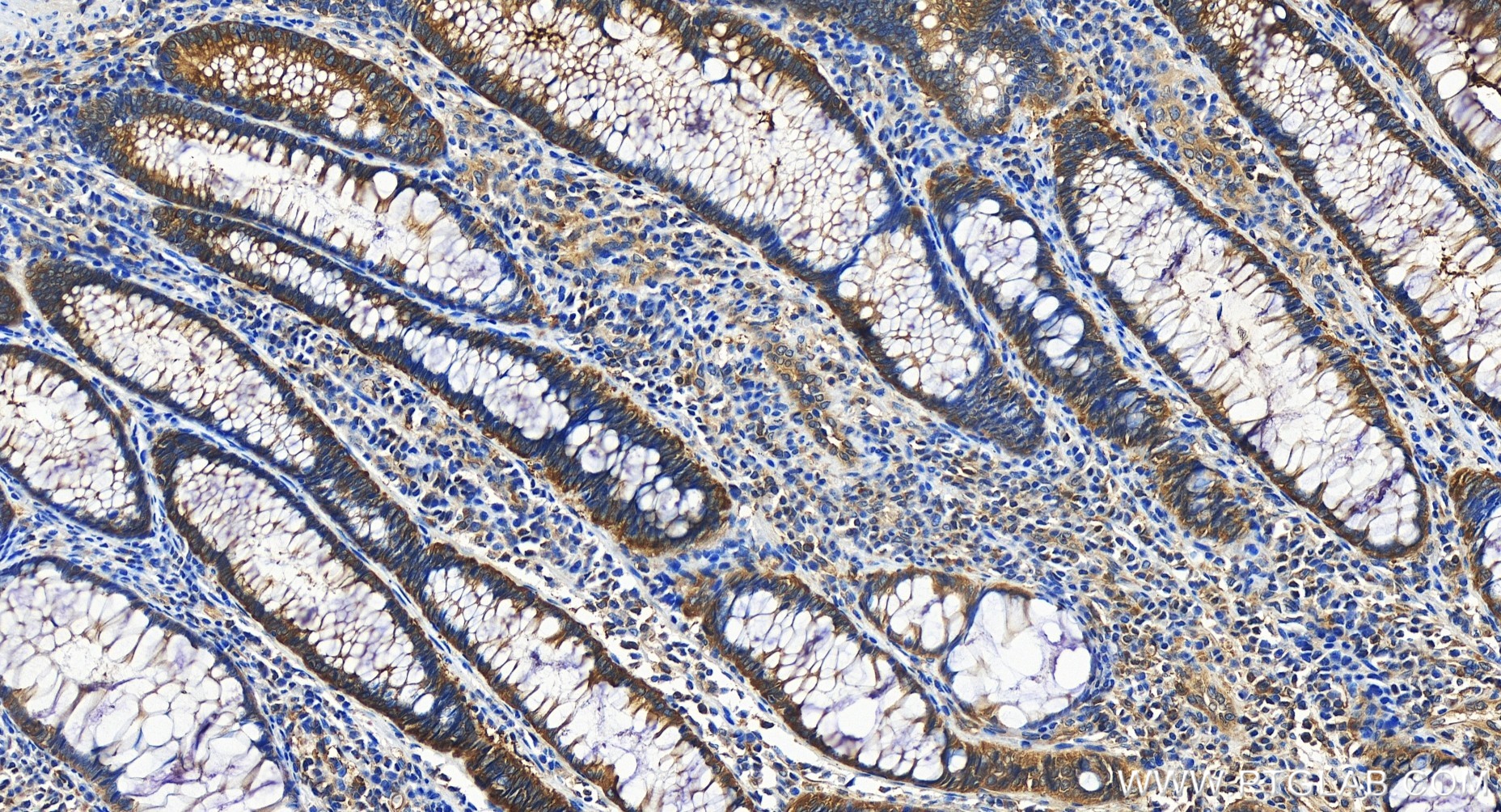 Immunohistochemistry (IHC) staining of human colon cancer tissue using MTHFD1 Recombinant antibody (84884-5-RR)