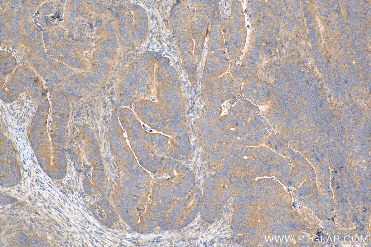 Immunohistochemistry (IHC) staining of human colon cancer tissue using mTOR Recombinant monoclonal antibody (81670-1-RR)
