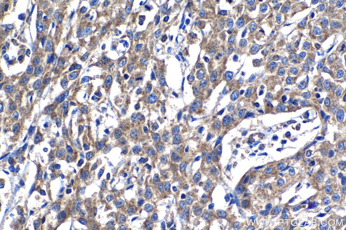 Immunohistochemistry (IHC) staining of human cervical cancer tissue using MTR Polyclonal antibody (25896-1-AP)