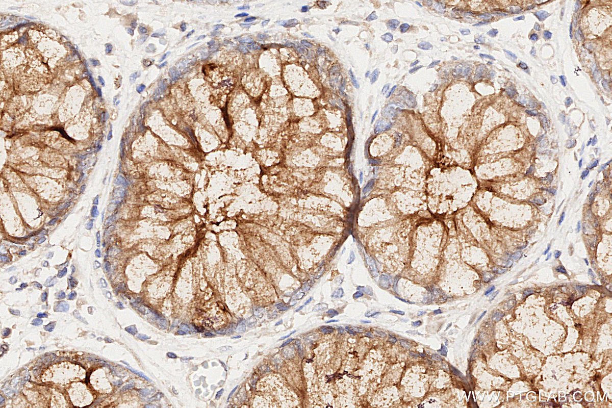 Immunohistochemistry (IHC) staining of human rectal cancer tissue using MUC1/CA15-3 Monoclonal antibody (60749-1-Ig)