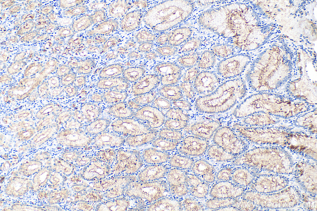 Immunohistochemistry (IHC) staining of human stomach cancer tissue using MUC1/CA15-3 Monoclonal antibody (60749-1-Ig)
