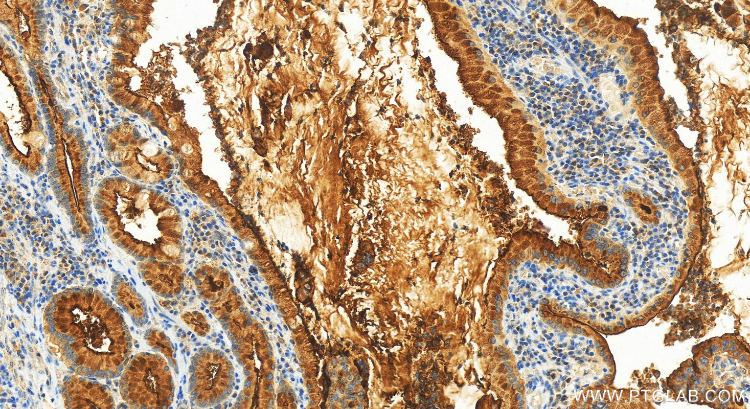 Immunohistochemistry (IHC) staining of human stomach cancer tissue using MUC1/CA15-3 C-terminal Recombinant antibody (83311-4-RR)