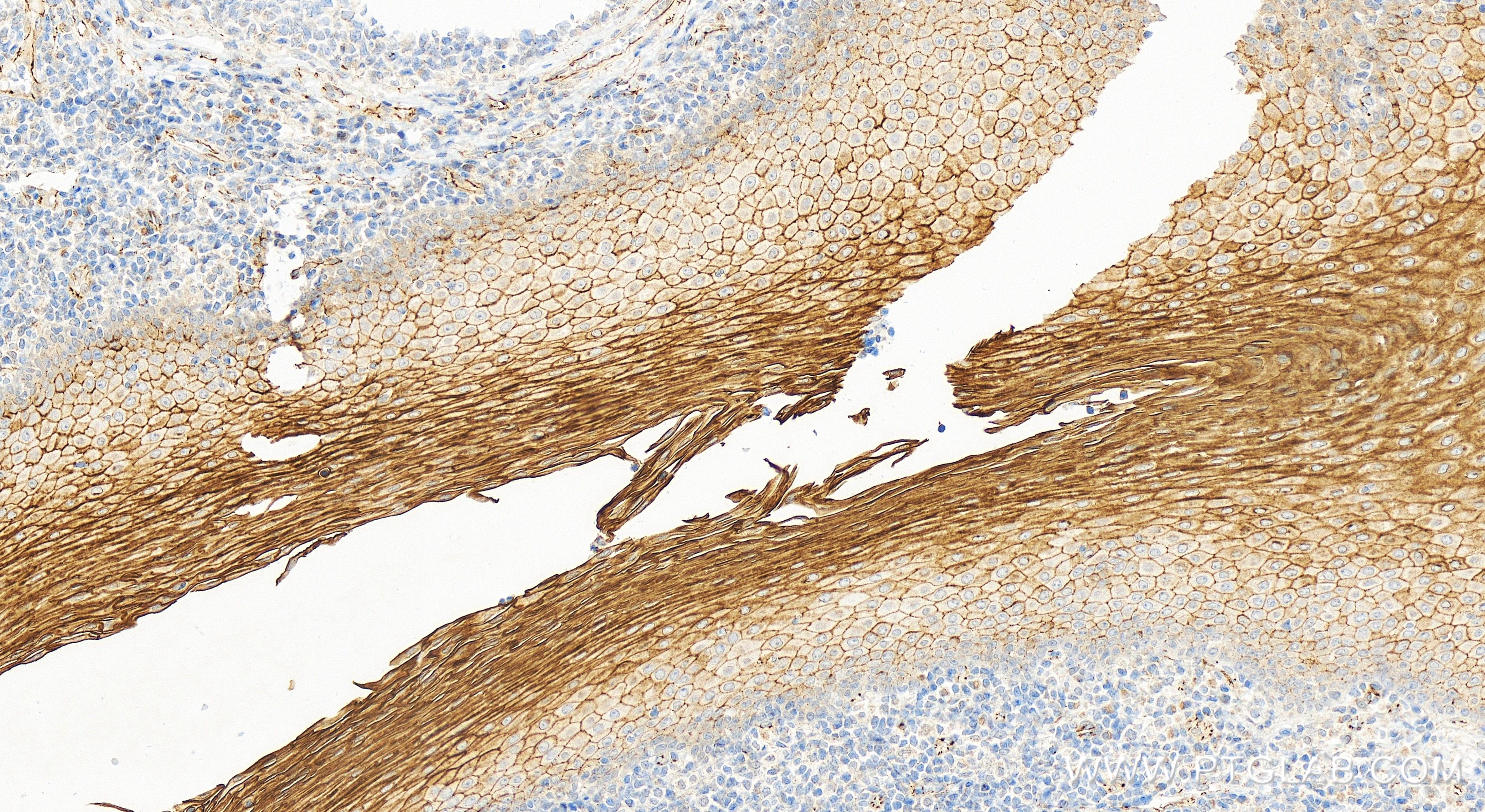 Immunohistochemistry (IHC) staining of human tonsillitis tissue using MUC1/CA15-3 C-terminal Recombinant antibody (83311-4-RR)