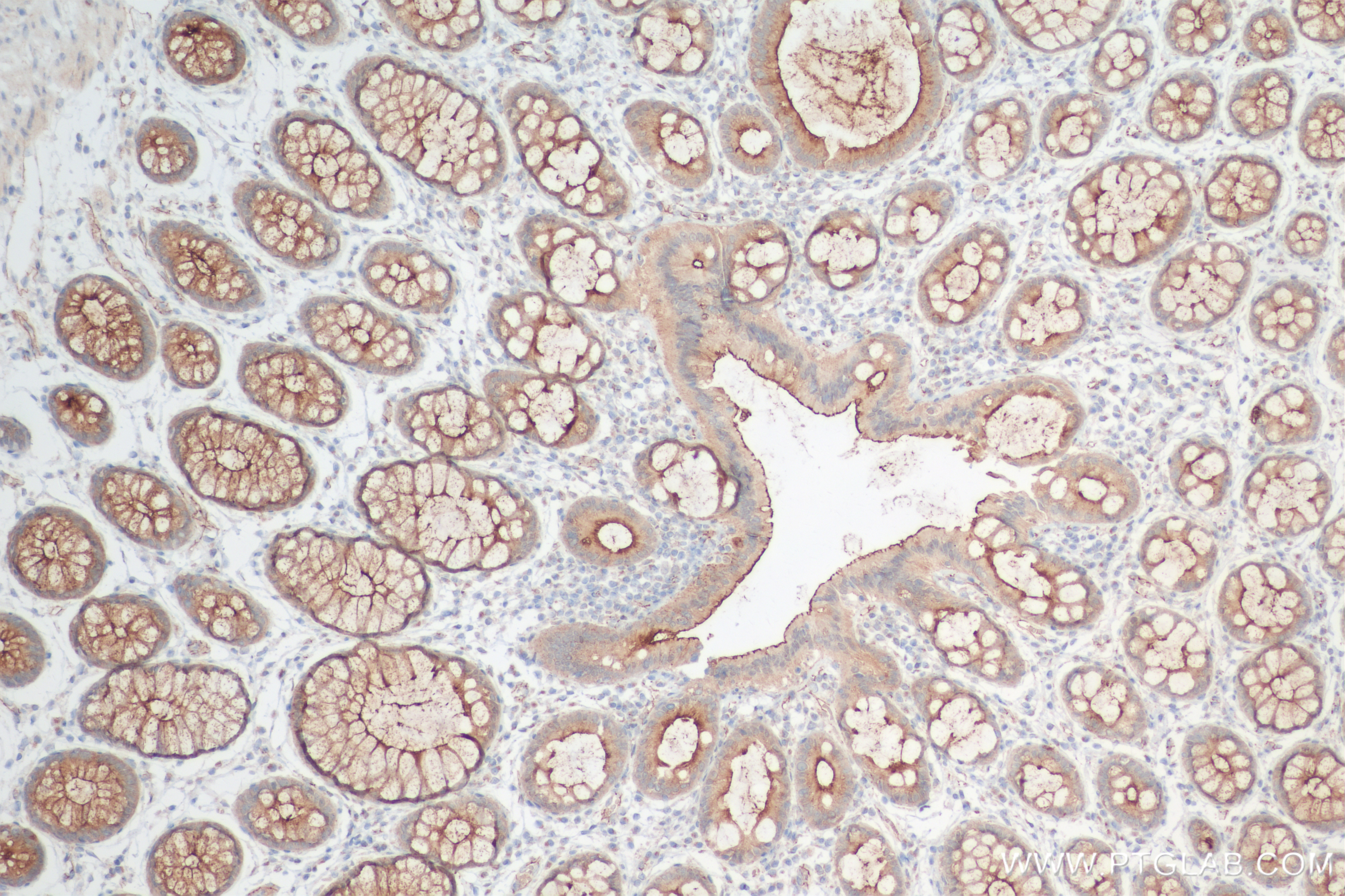 Immunohistochemistry (IHC) staining of human rectal cancer tissue using MUC1/CA15-3 C-terminal Recombinant antibody (83311-4-RR)