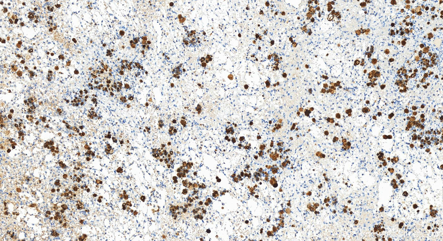 Immunohistochemistry (IHC) staining of human ovary cancer tissue using MUC1/CA15-3 C-terminal Recombinant antibody (83311-4-RR)