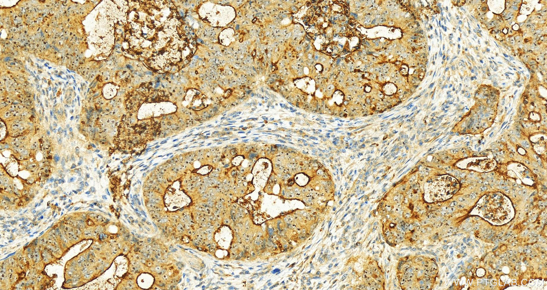 Immunohistochemistry (IHC) staining of human colon cancer tissue using MUC13 Polyclonal antibody (55487-1-AP)