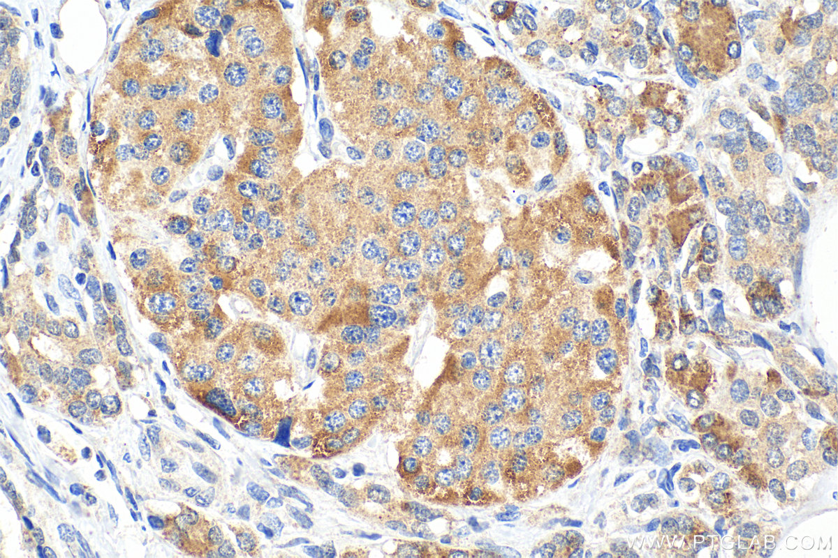 Immunohistochemistry (IHC) staining of human pancreas cancer tissue using MUC2 Polyclonal antibody (27675-1-AP)