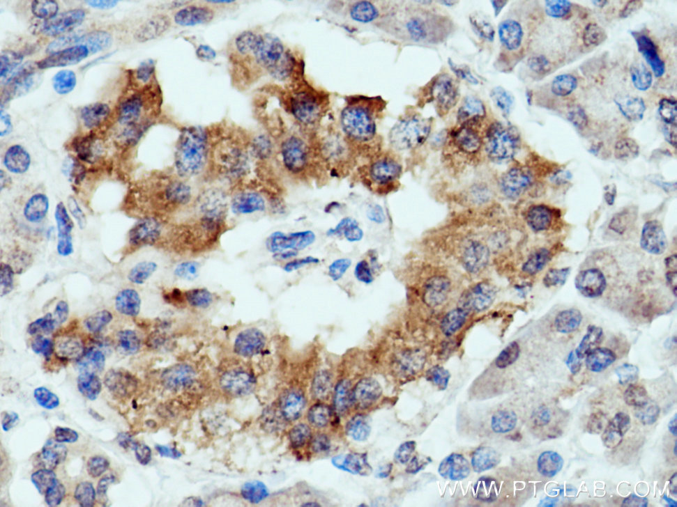 Immunohistochemistry (IHC) staining of human pancreas cancer tissue using MUC5AC Polyclonal antibody (20725-1-AP)