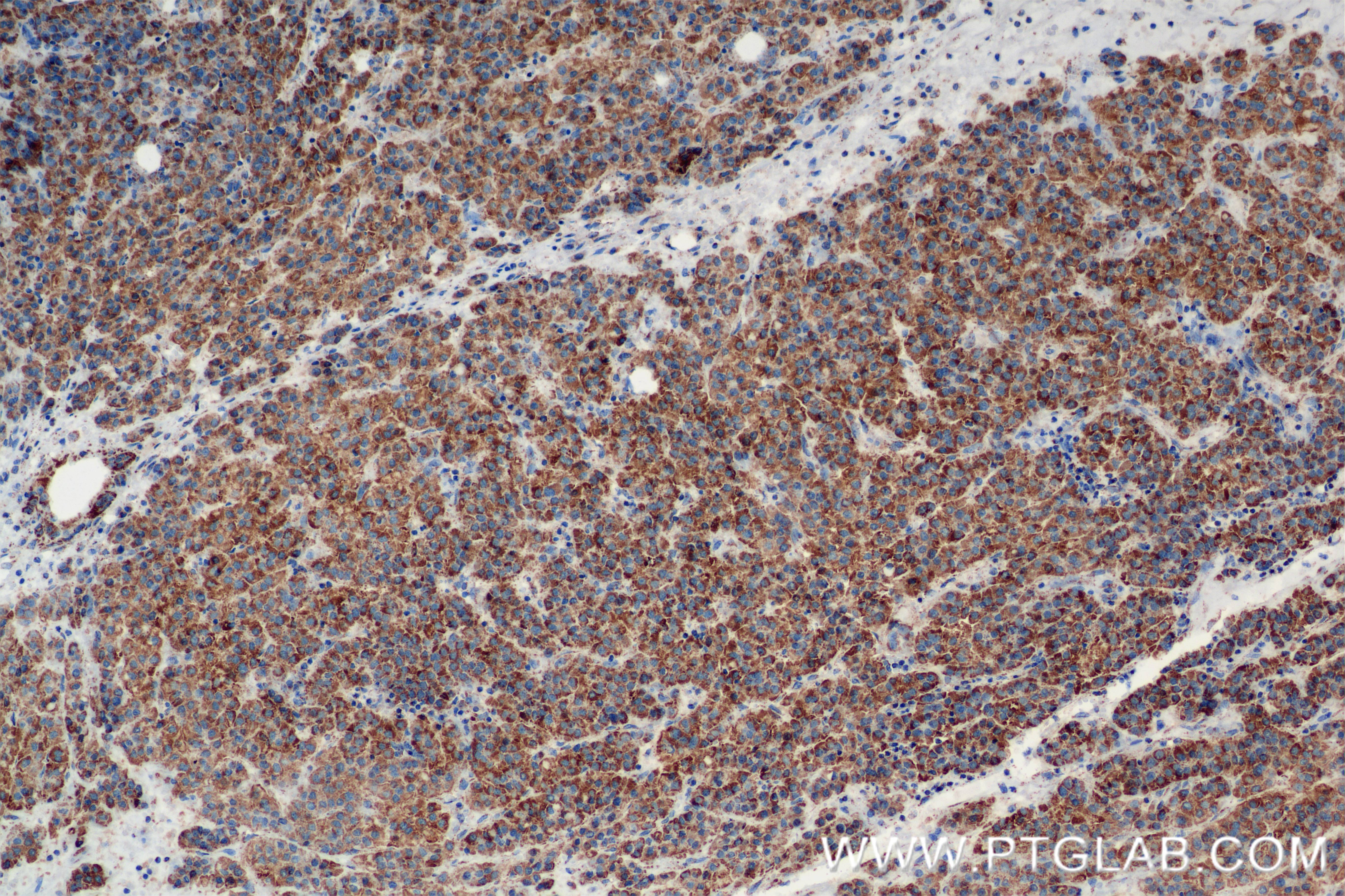 Immunohistochemistry (IHC) staining of Human Hepatocellular cancer using Methylmalonyl Coenzyme A mutase/MUT Recombinant an (84879-6-RR)