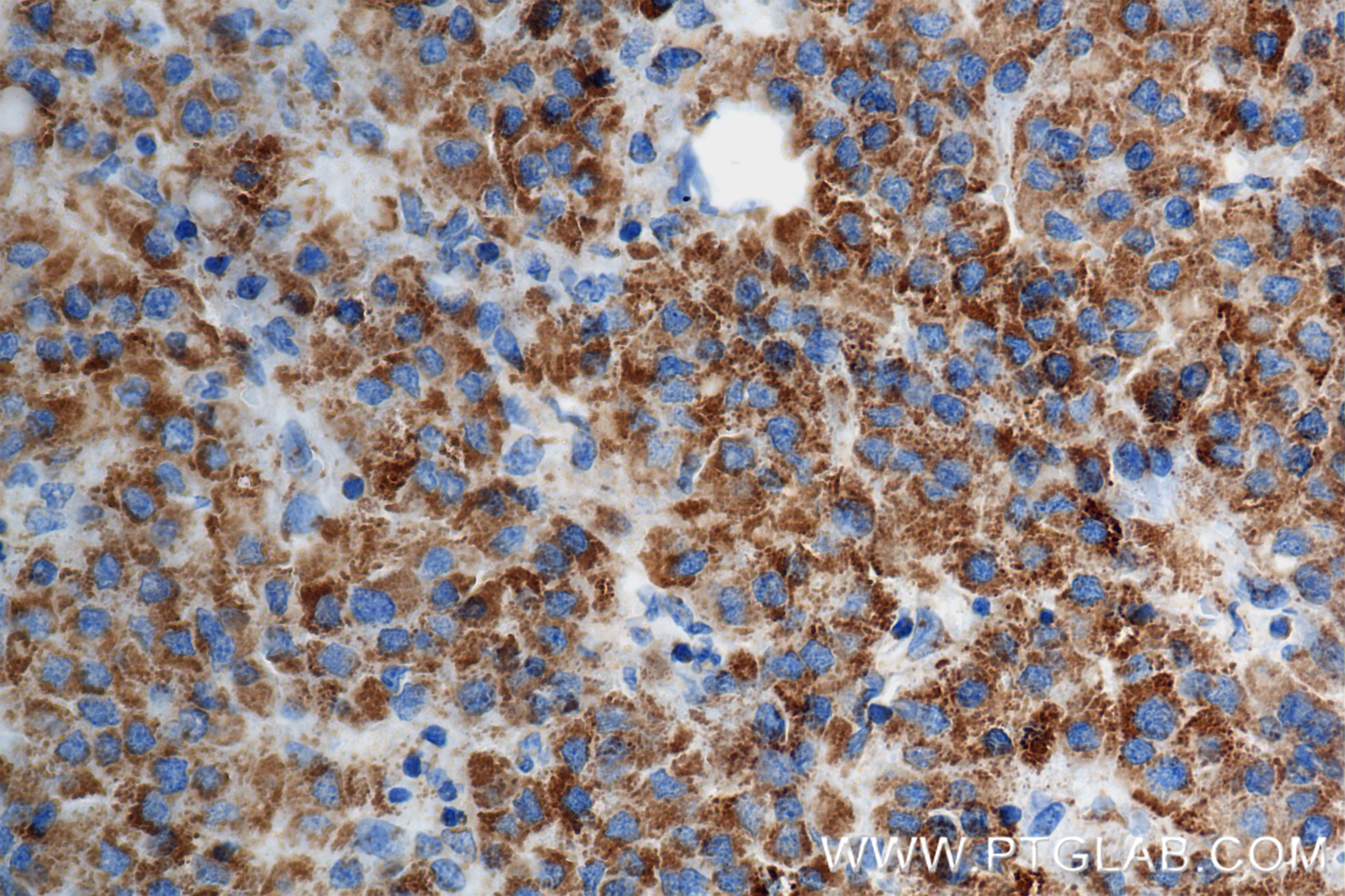 Immunohistochemistry (IHC) staining of Human Hepatocellular cancer using Methylmalonyl Coenzyme A mutase/MUT Recombinant an (84879-6-RR)