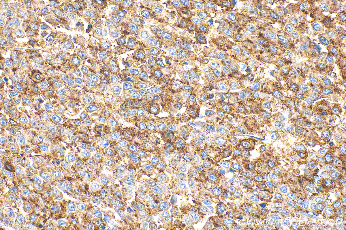 Immunohistochemistry (IHC) staining of human colon cancer tissue using MX1 Polyclonal antibody (13750-1-AP)