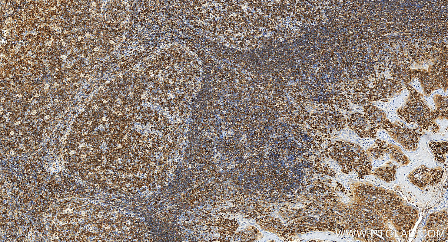 Immunohistochemistry (IHC) staining of human tonsillitis tissue using MX1 Polyclonal antibody (13750-1-AP)