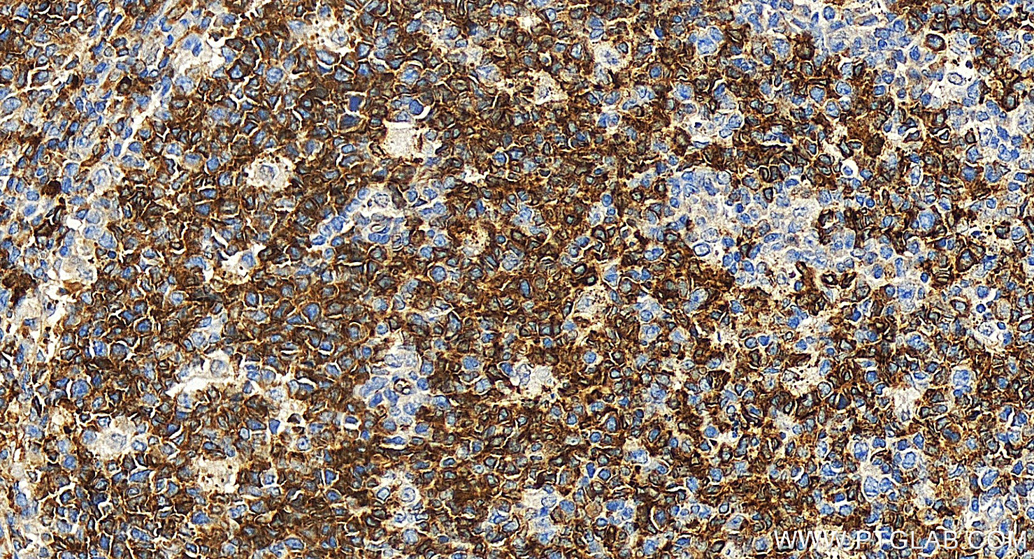 Immunohistochemistry (IHC) staining of human tonsillitis tissue using MX1 Polyclonal antibody (13750-1-AP)