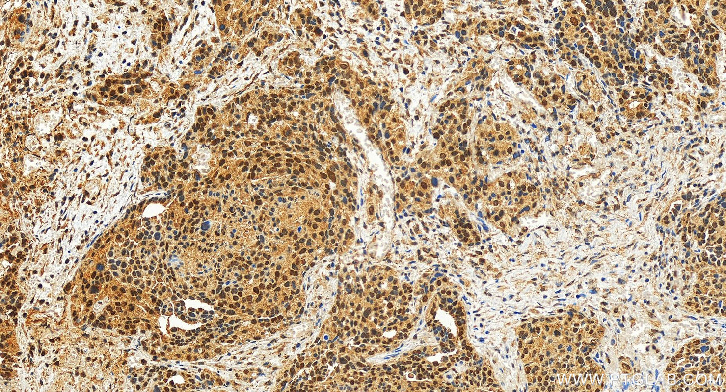 Immunohistochemistry (IHC) staining of human ovary cancer tissue using c-MYC Polyclonal antibody (10828-1-AP)