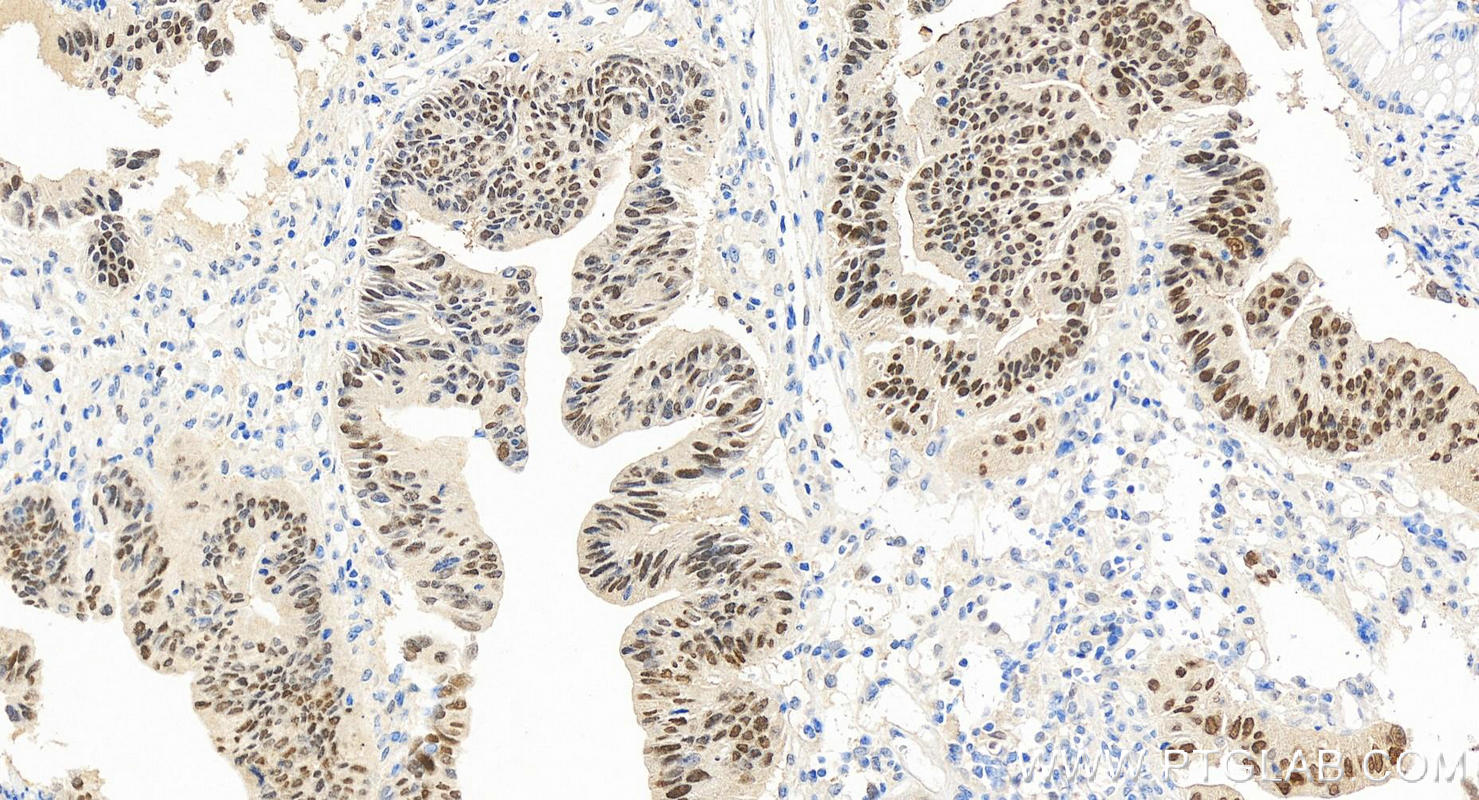 Immunohistochemistry (IHC) staining of human colon cancer tissue using c-MYC Recombinant antibody (80845-1-RR)