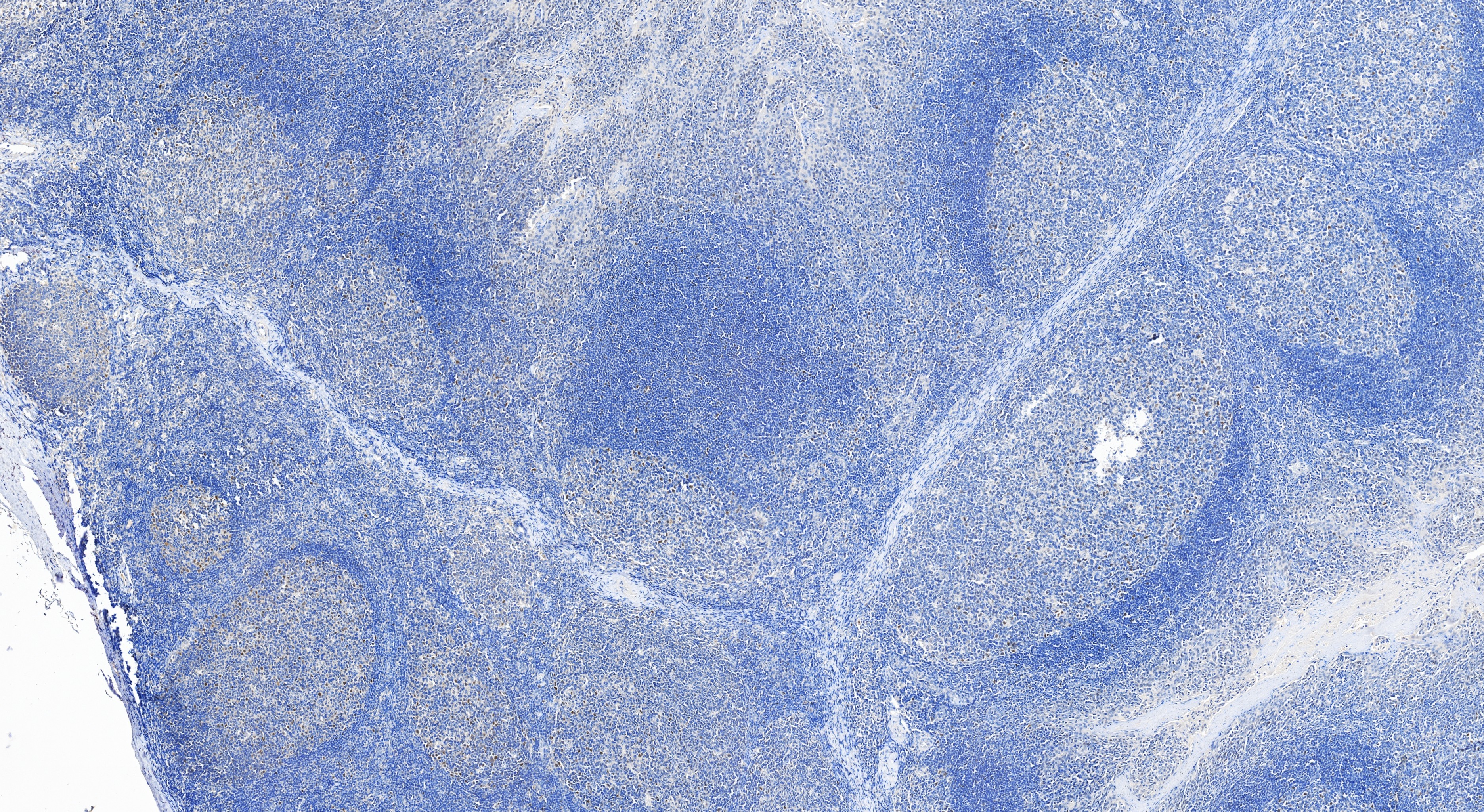 Immunohistochemistry (IHC) staining of human tonsillitis tissue using c-MYC Recombinant monoclonal antibody (80845-1-RR)