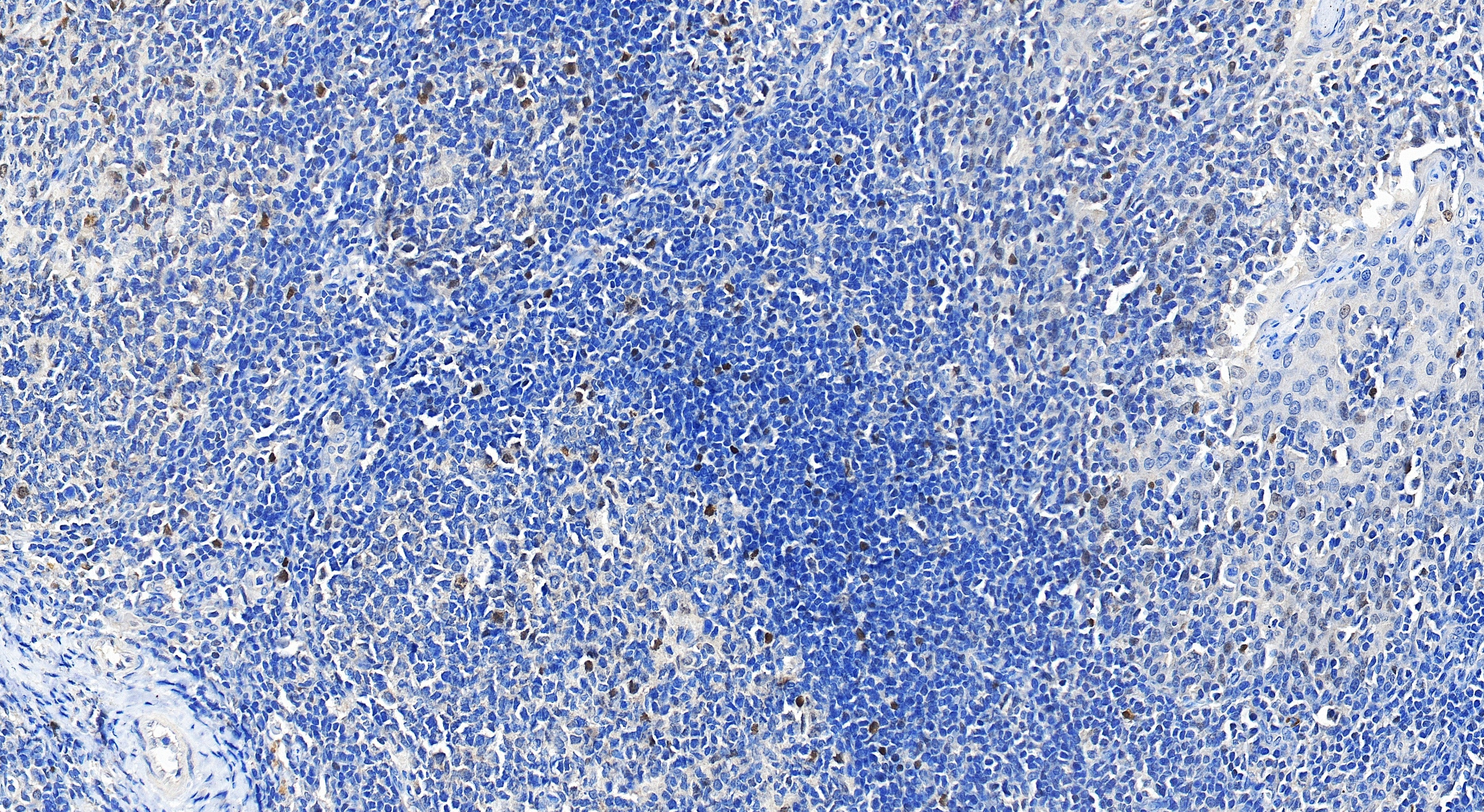 Immunohistochemistry (IHC) staining of human tonsillitis tissue using c-MYC Recombinant monoclonal antibody (80845-1-RR)